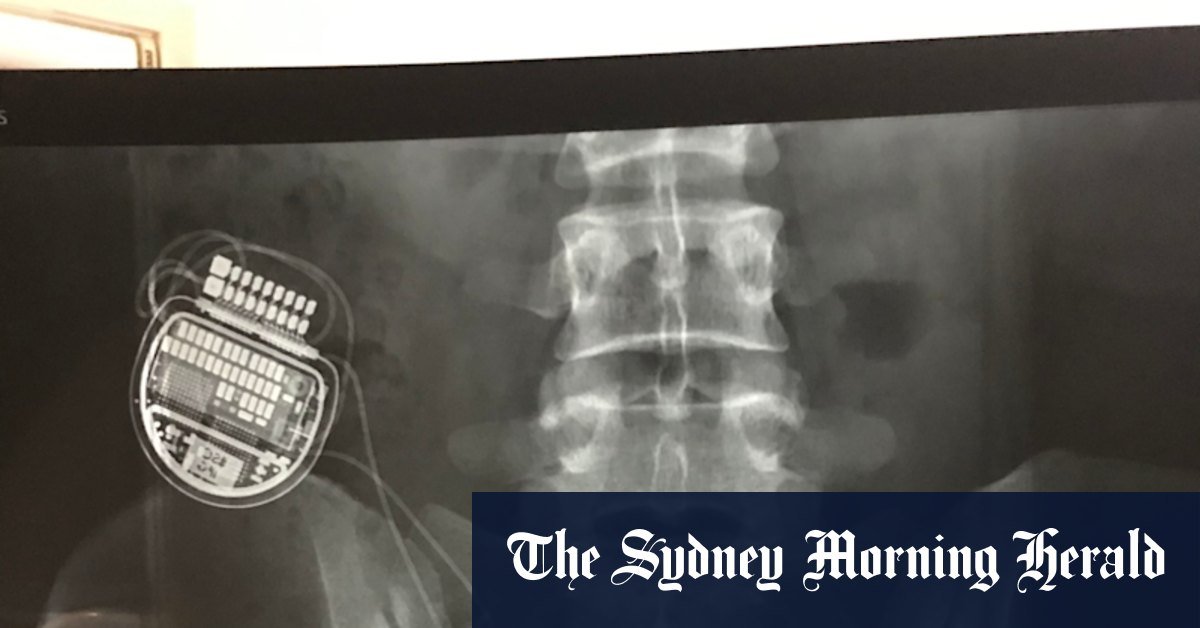 These spinal treatments cost more than $ 50,000. A new study found "they don't have work '